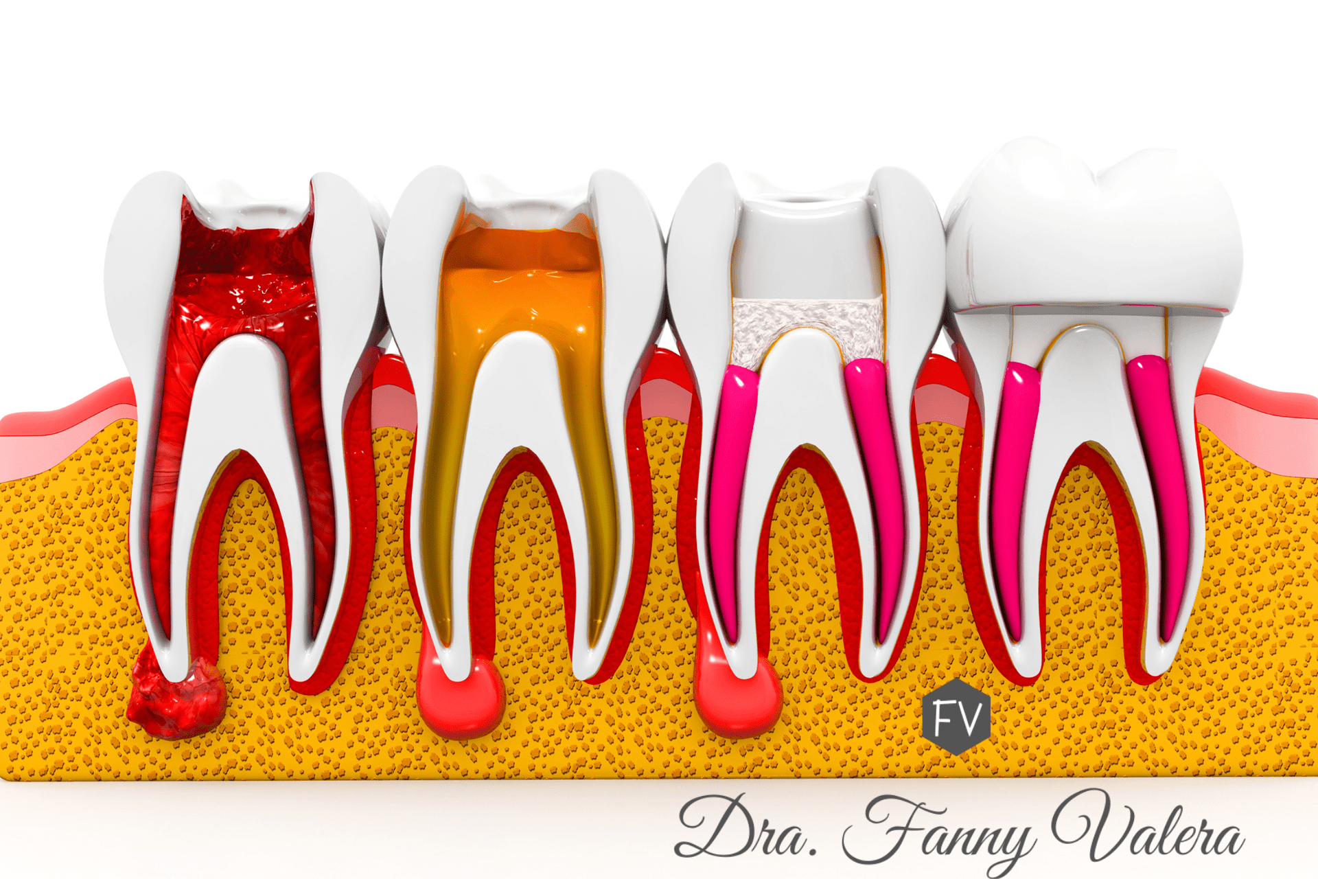 root canal Cartagena, endodontic treatment Colombia, tooth pain relief Cartagena, save infected tooth Cartagena, dental emergency care for international patients, dental prices, Root canal prices