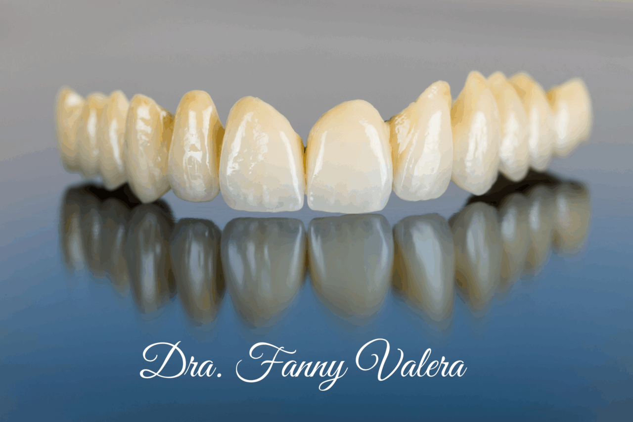 dental bridge smile makeover cartagena dental clinic dental bridge, smile makeover cartagena, dental clinic, dental bridges prices cartagena, zirconia dental bridges