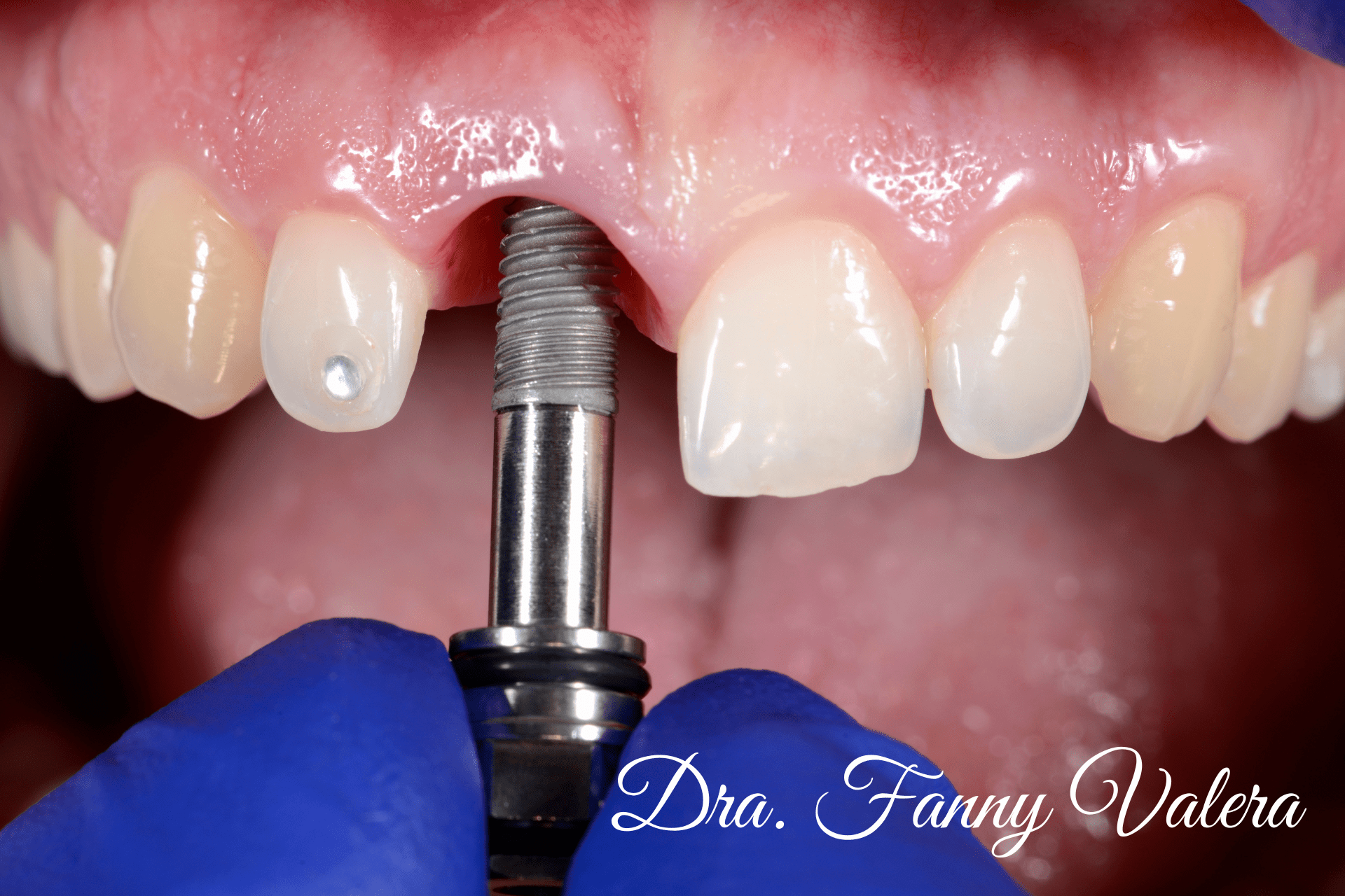 dental implant smile makeover cartagena colocacion de implante, dental implant, dental implan catagena prices