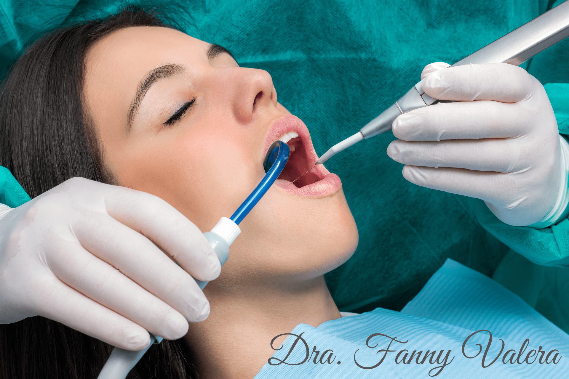 carillas, de resina, diseño de sonrisa carillas de resina, composite veneers, composite veneers package cartagena