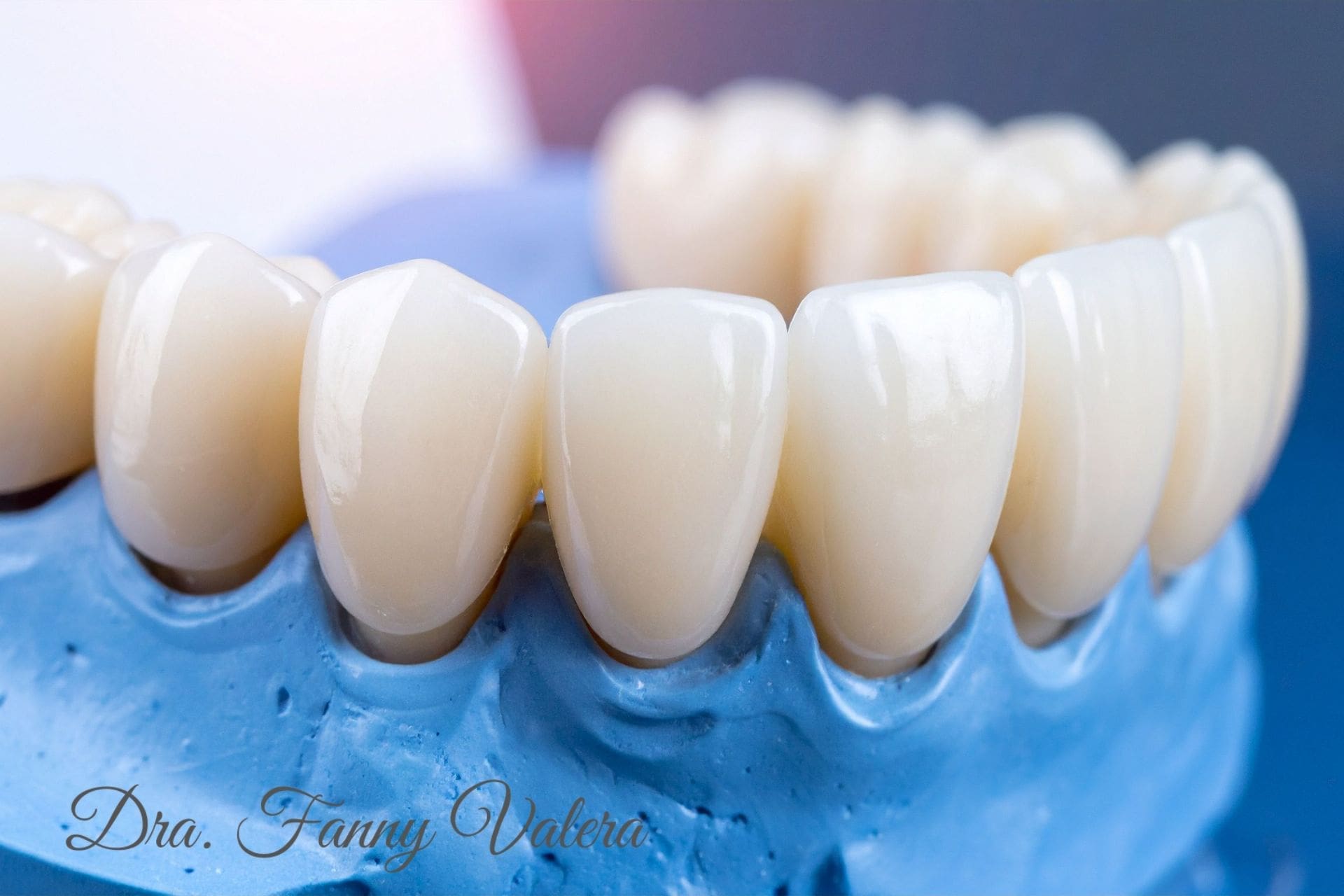 smile makeover no implants cartagena package paquete smile makeover sin implantes, smile makeover no implans package cartagena prices