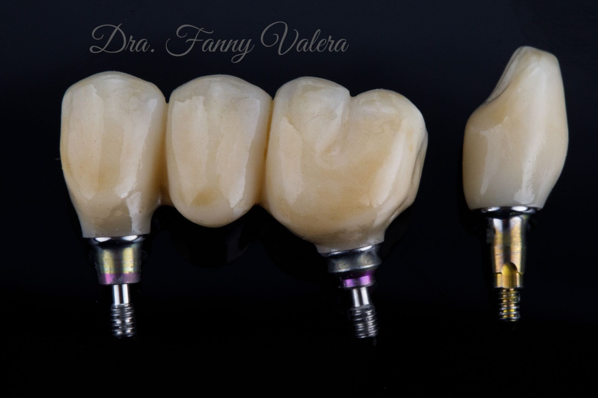 combo implante y corona, package dental implant and zirconia crown, prices dental implant cartagena