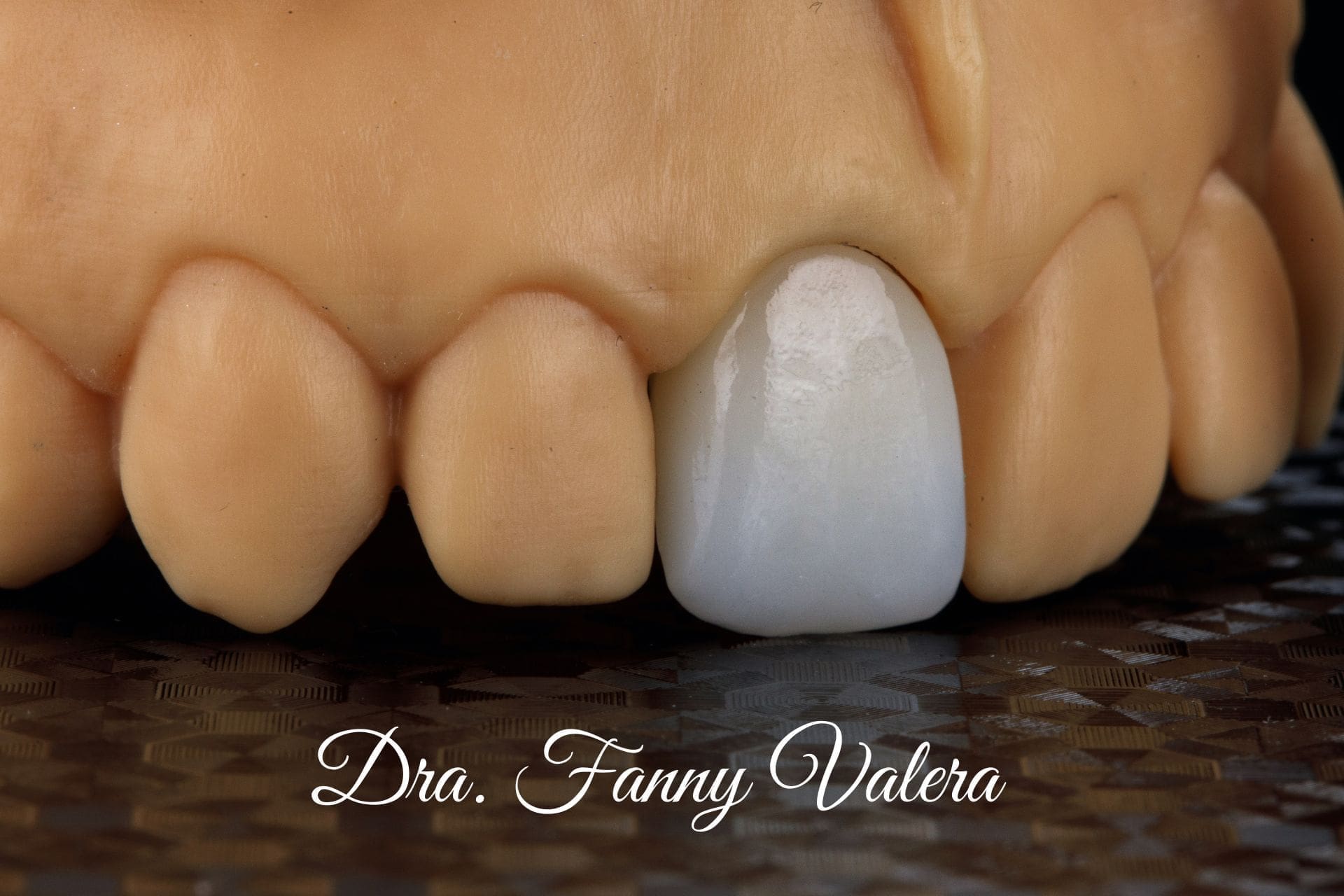 tratamiento smile makeover cartagena (1) dental crown, corona dental, zirconia dental crown, dental crown prices cartagena